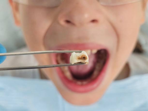 Best Emergency Wisdom Teeth Removal in St John, KS